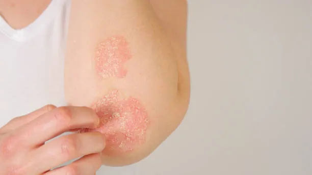 تعريف الأكزيما types of eczema and methods of treatment in riyadh
