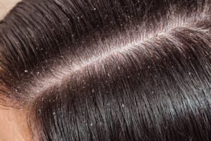 woman's unhealthy head skin